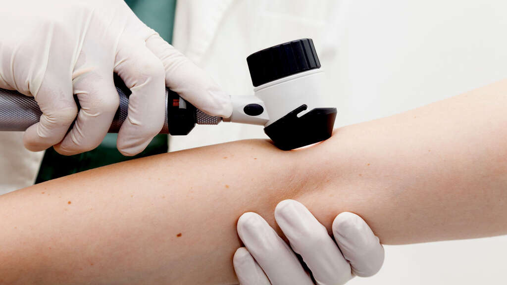 Scleroderma