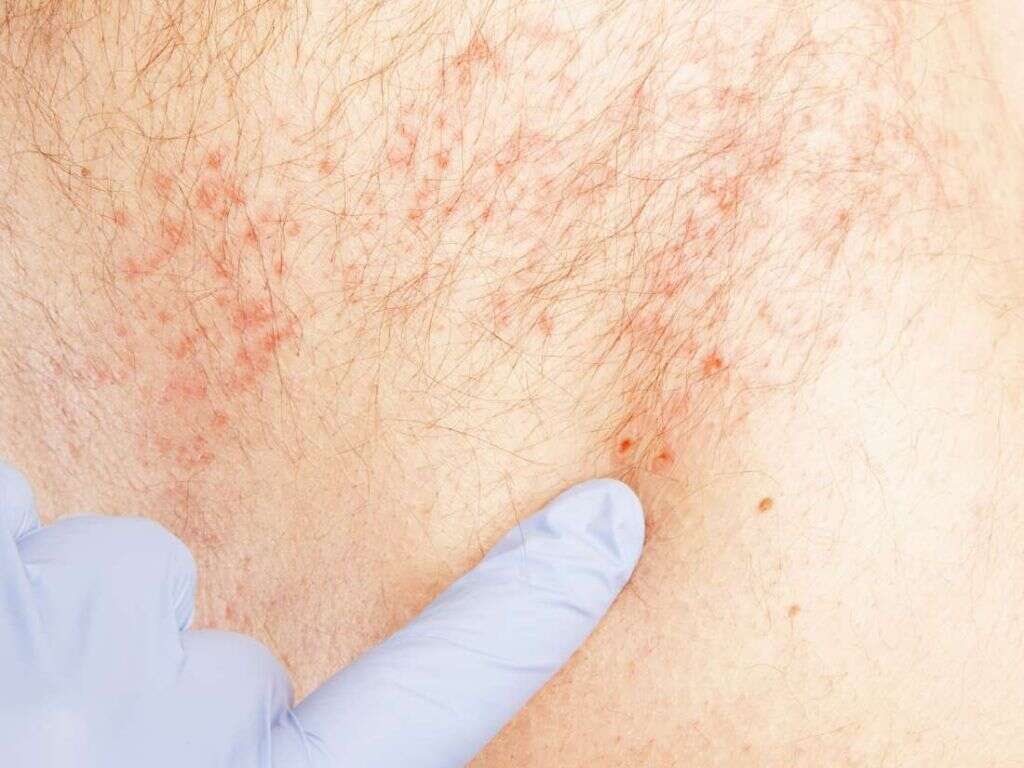 Shingles