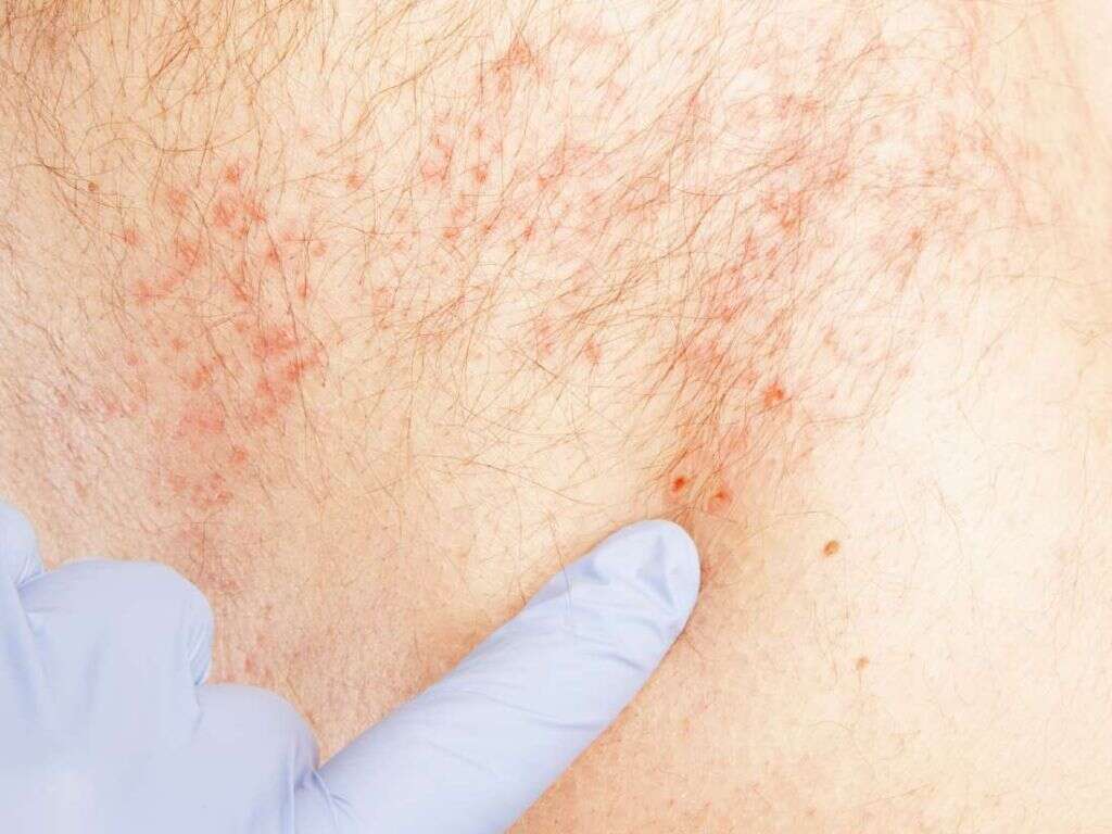 shingles-what-is-shingles