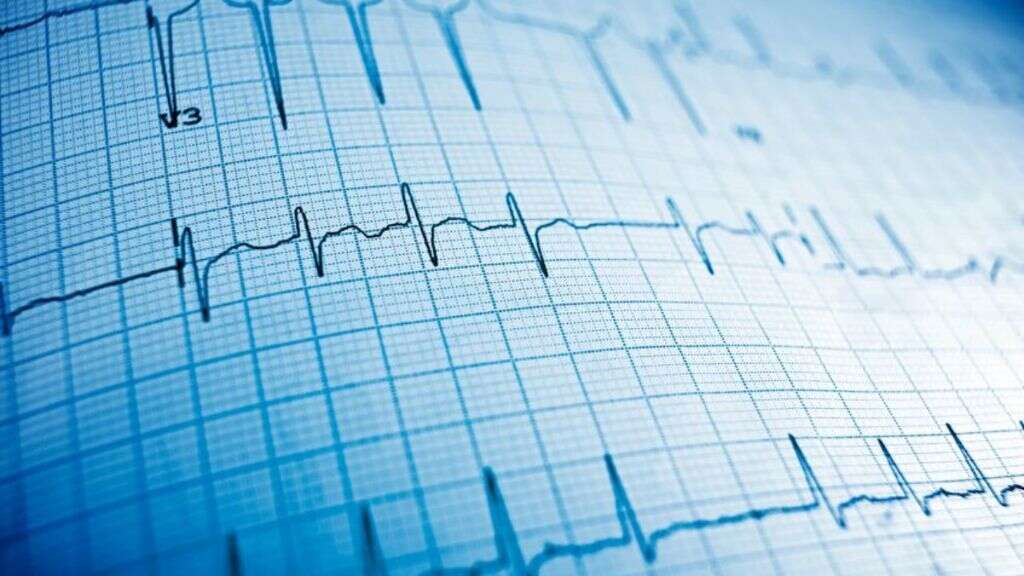 Sick Sinus Syndrome