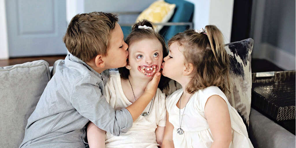 Sotos Syndrome