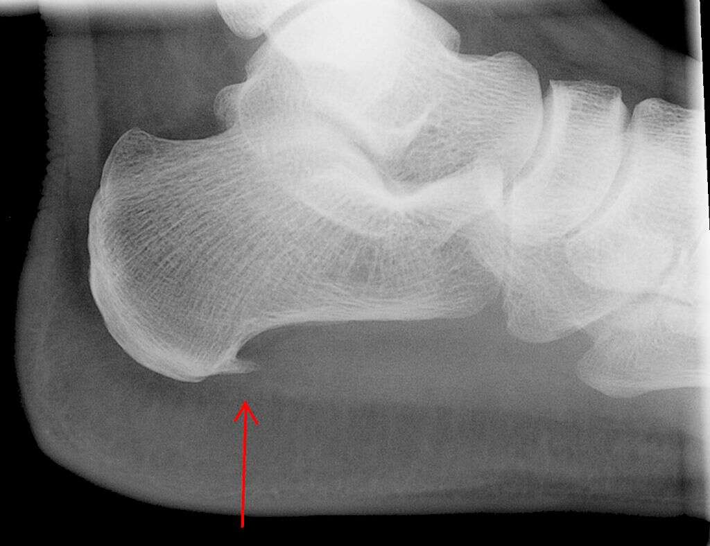 Spondylosis