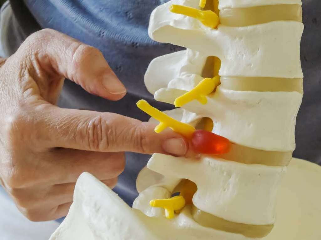 Spondylosis