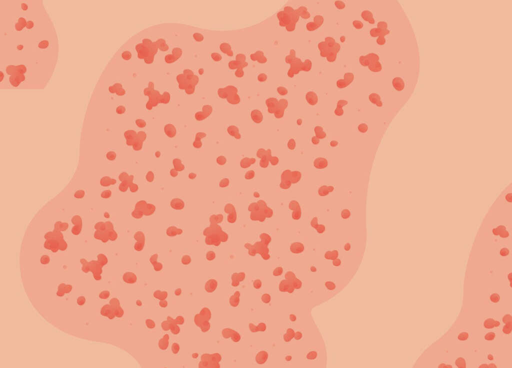 Steven Johnson Syndrome