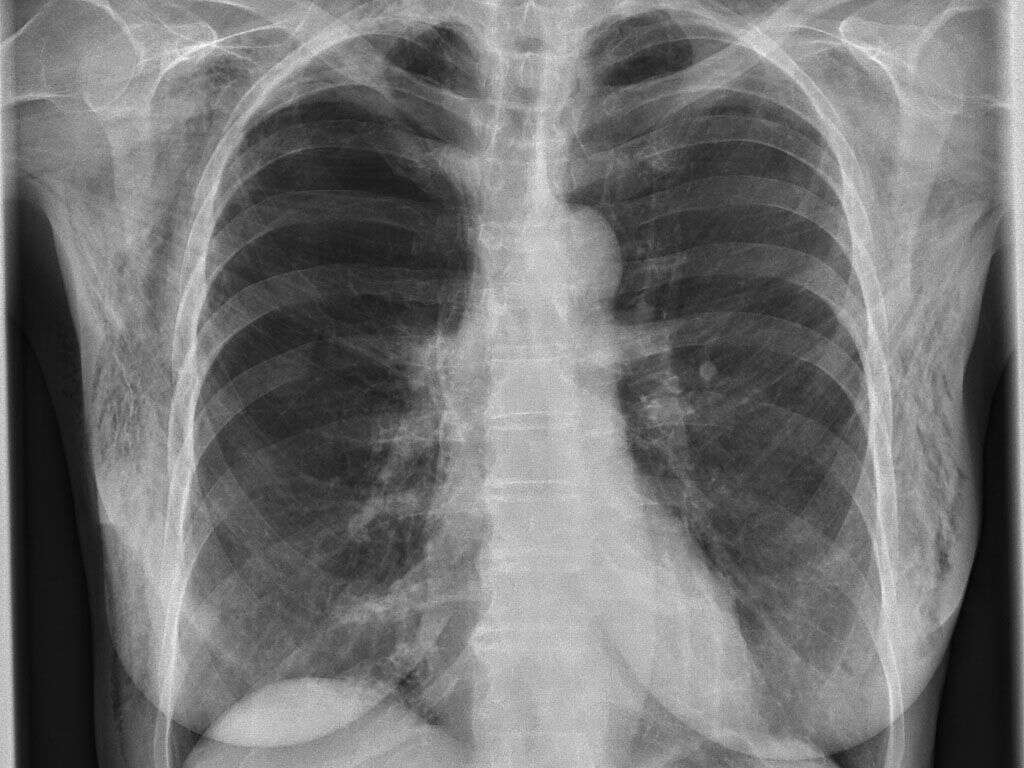 Subcutaneous Emphysema