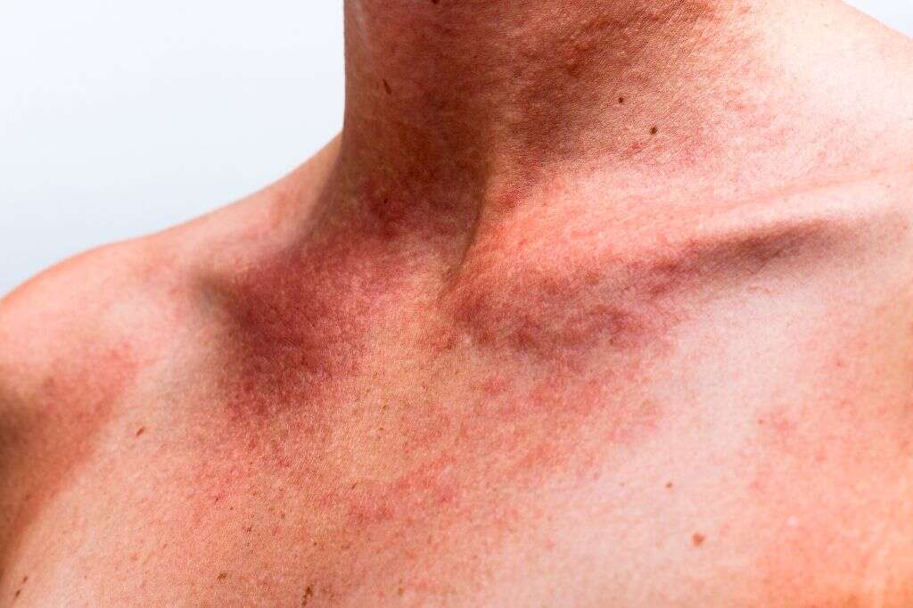 Sun Poisoning