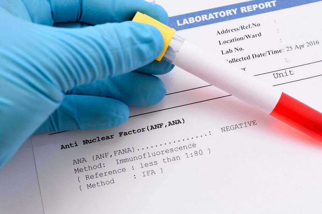 Systemic Lupus
