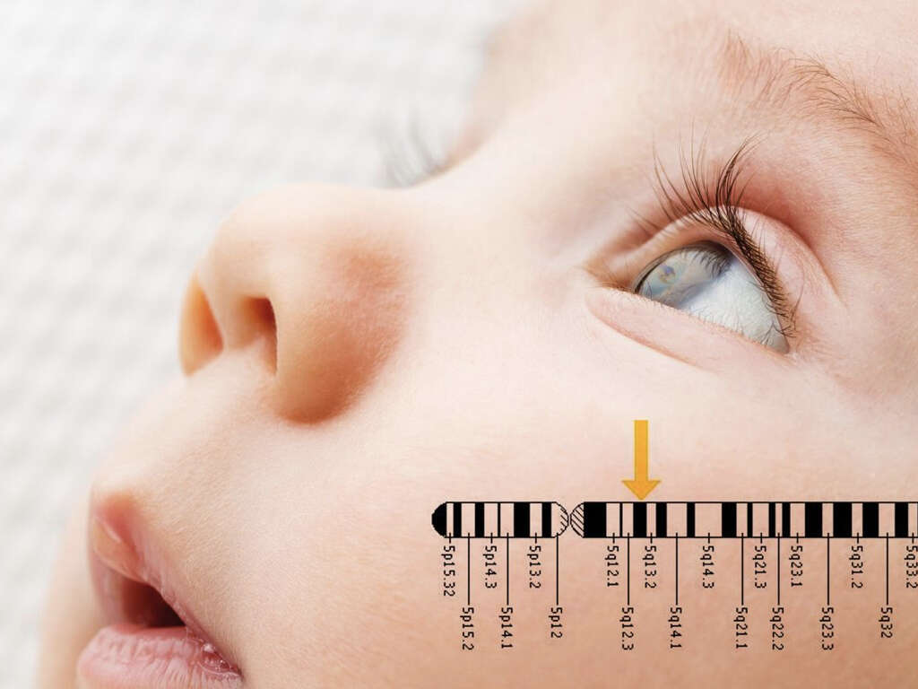 Tay-Sachs Disease