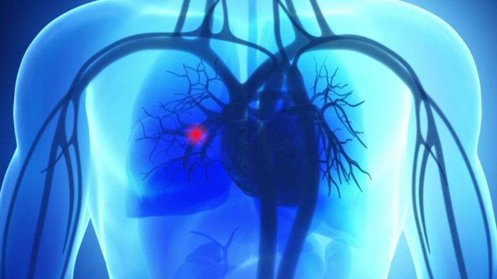 Thrombophlebitis