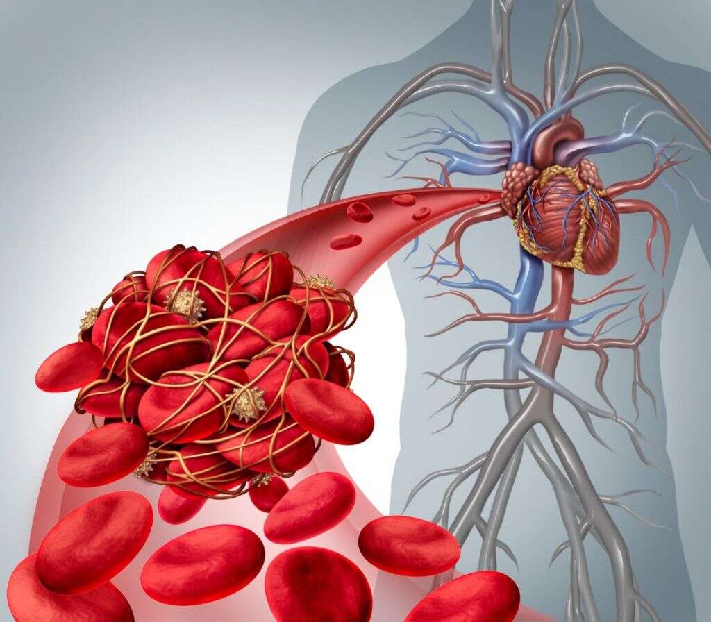 Thrombophlebitis