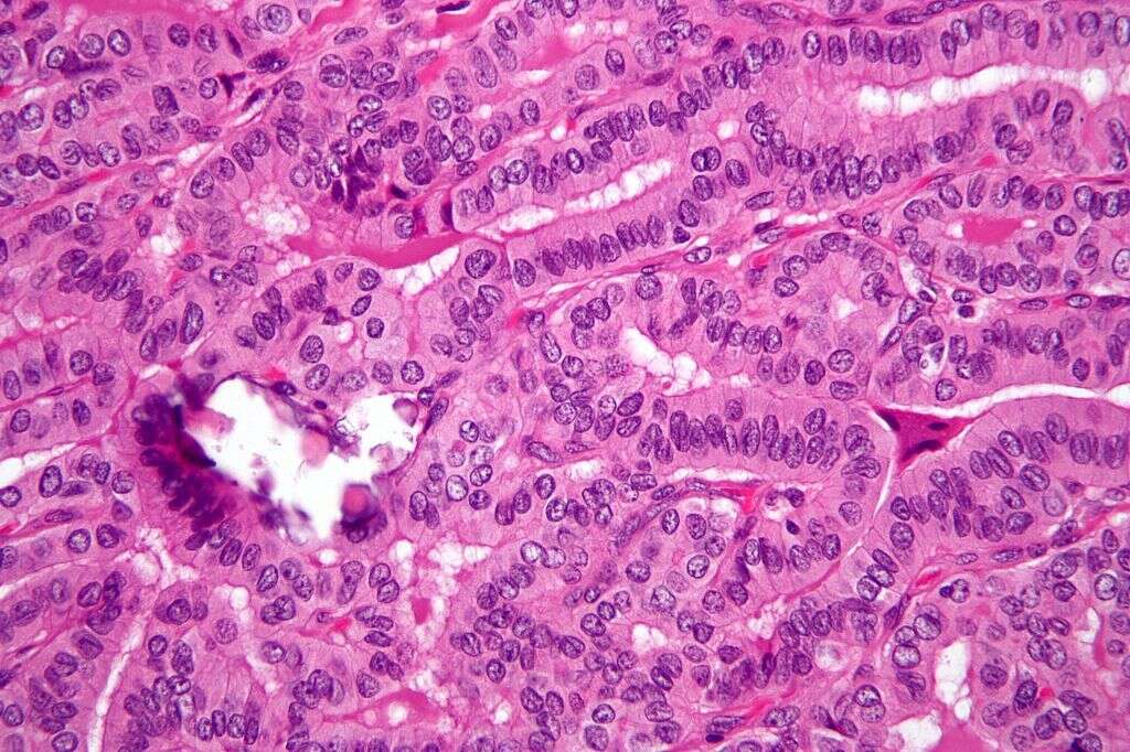 Thyroid Cancer