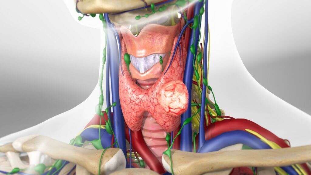 Thyroid Cancer
