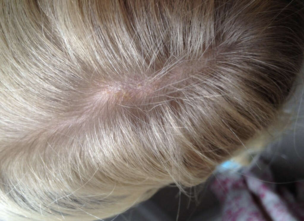 Tinea Capitis