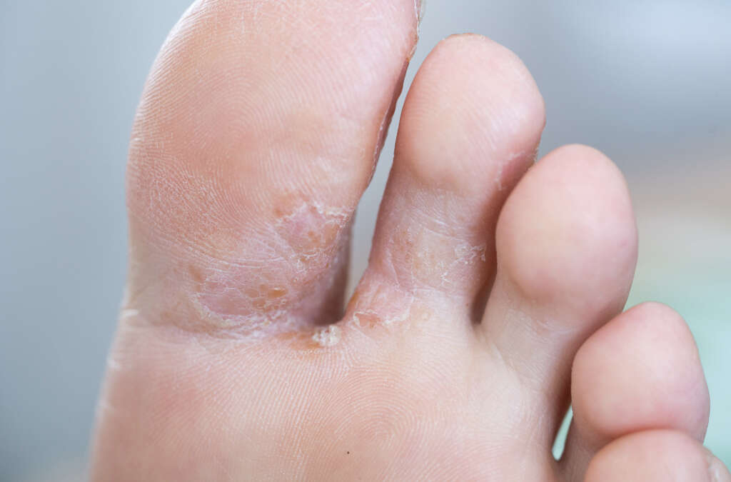 Tinea Pedis