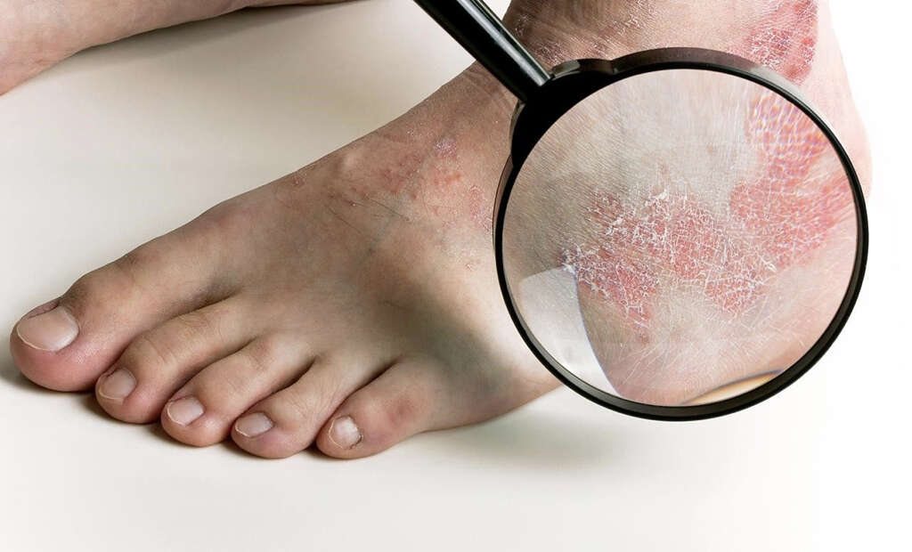 Tinea Pedis