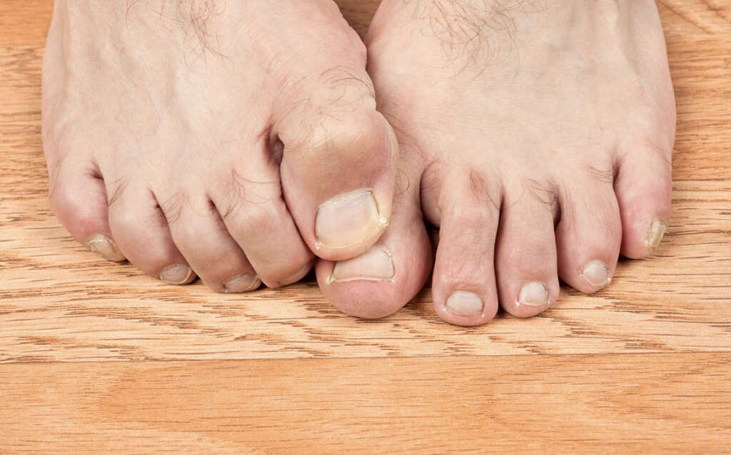 Tinea Pedis