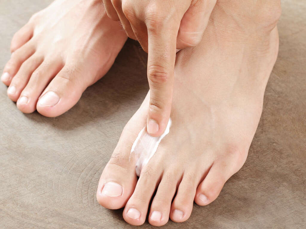 Tinea Pedis