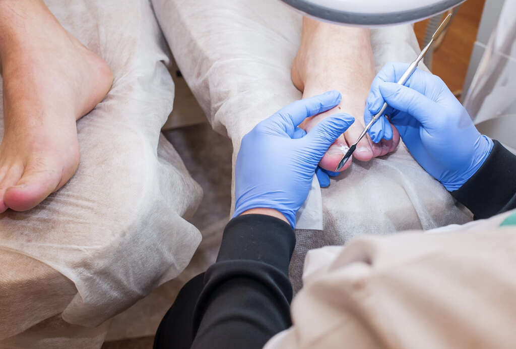 Tinea Pedis