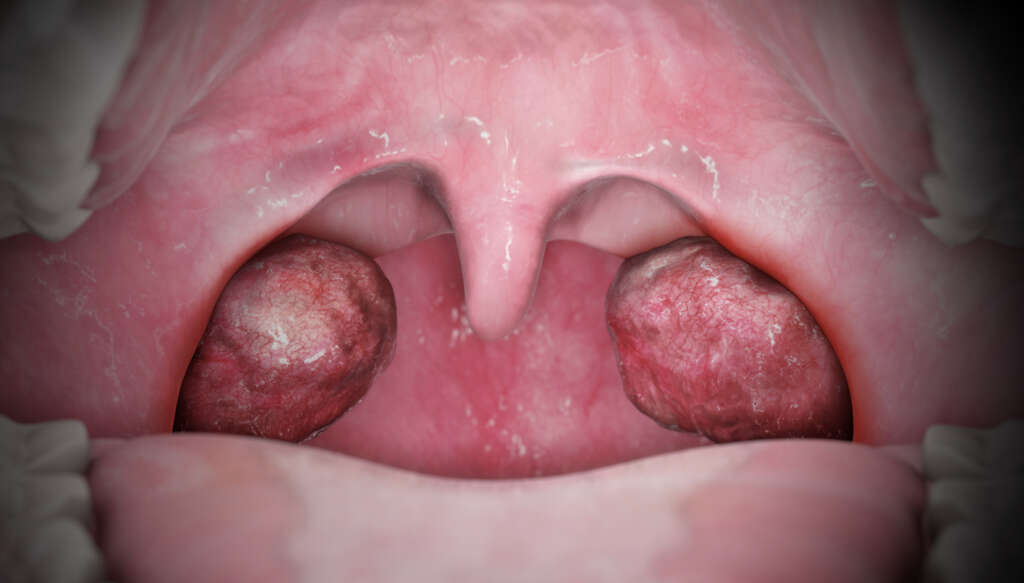 Tonsilitis