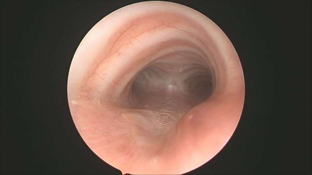 Tracheitis