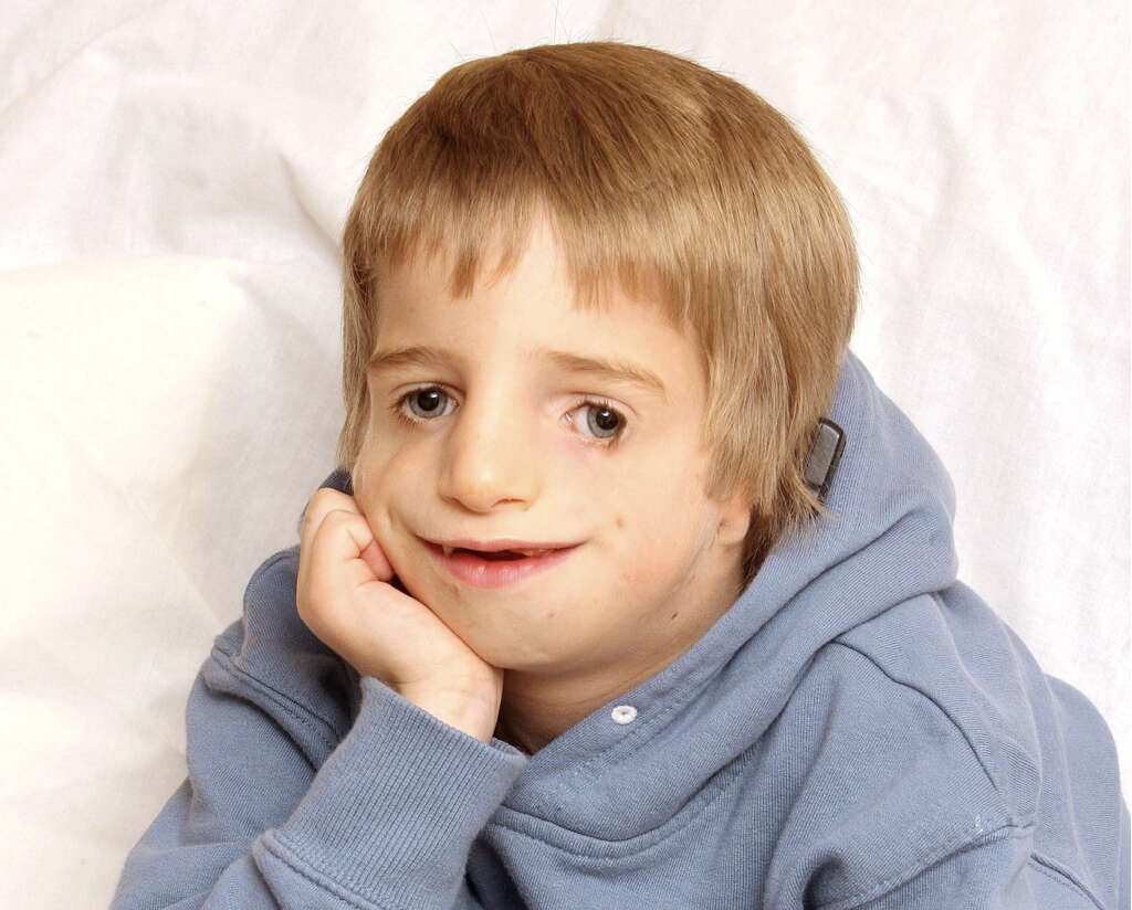 Treacher Collins Syndrome