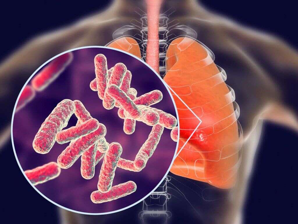 Tuberculosis