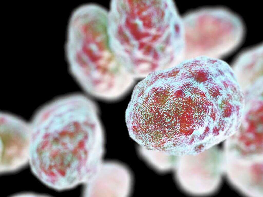 Tularemia
