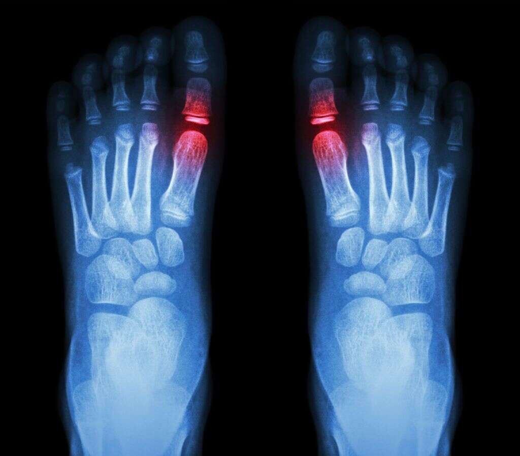 Turf Toe