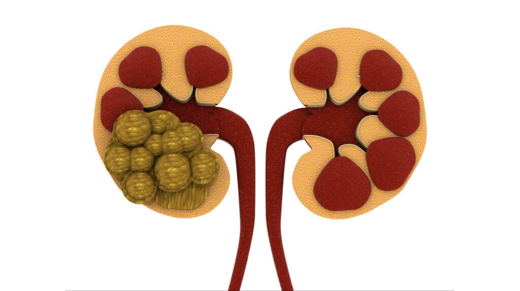 Uremia