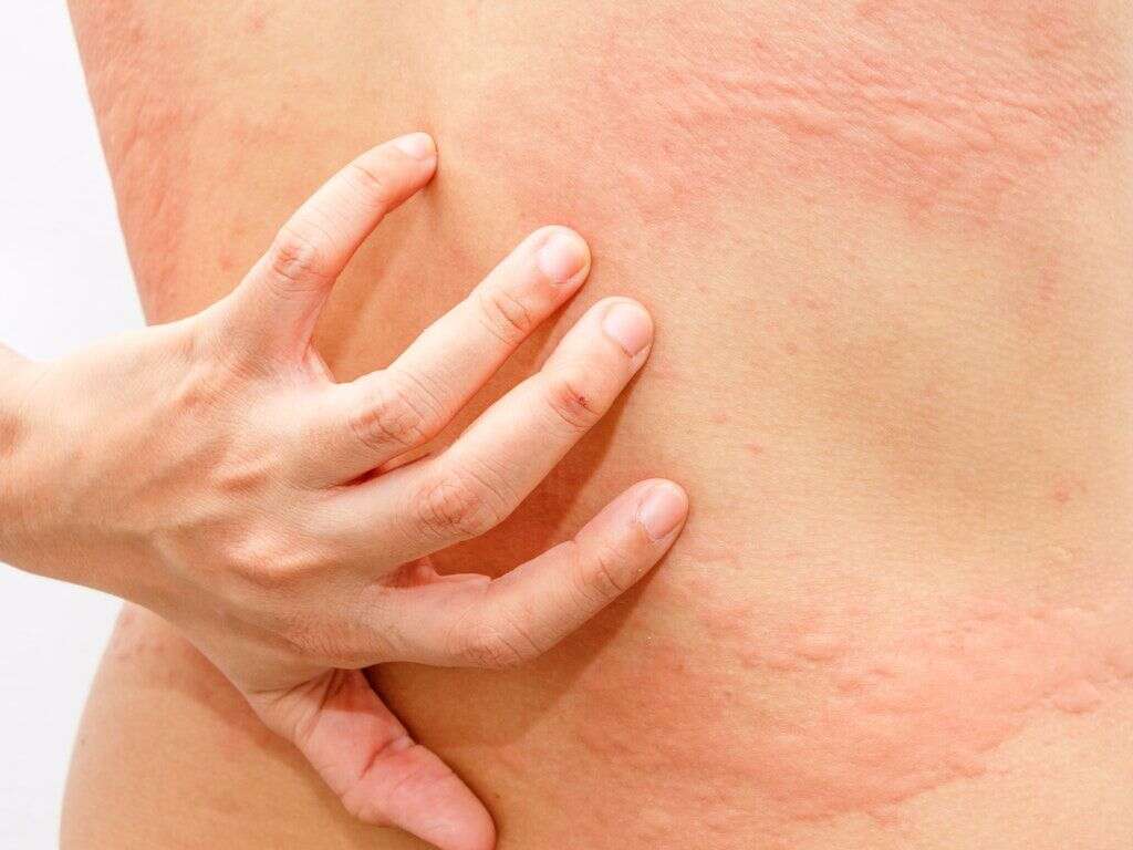 Urticaria