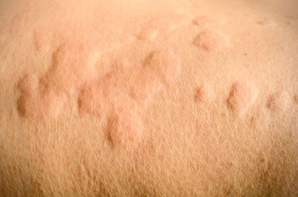 Urticaria