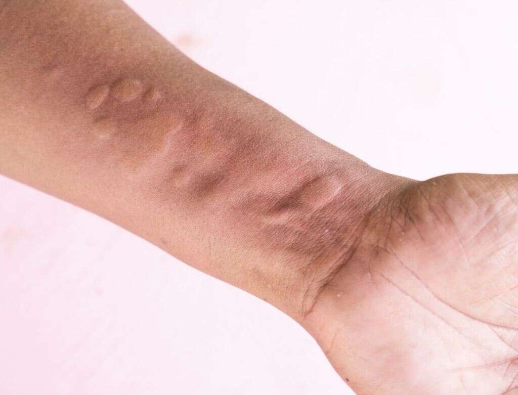 Urticaria