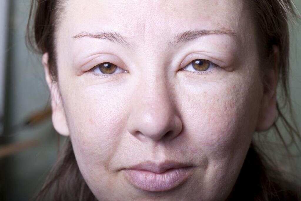 Urticaria