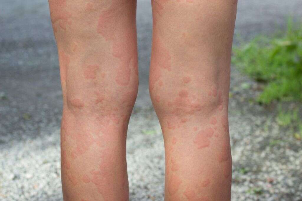 Urticaria