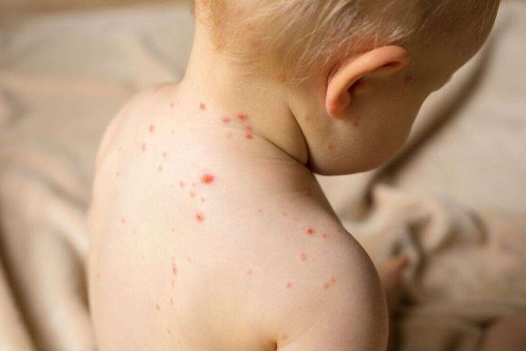 Varicella