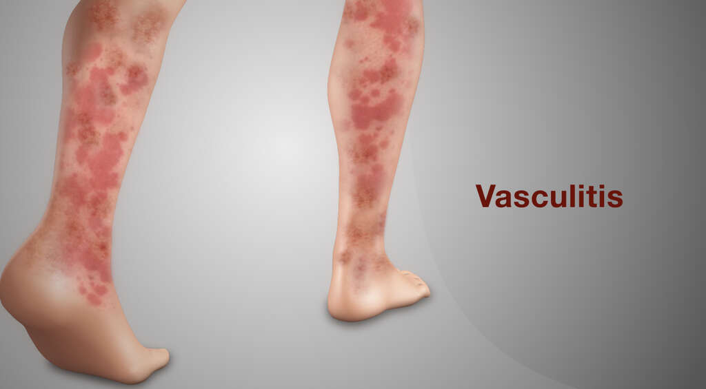 Vasculitis