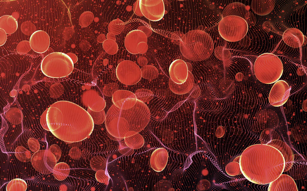 Vasculitis