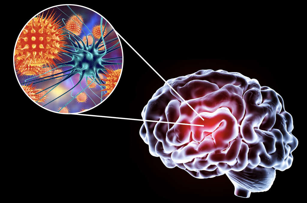 Viral Encephalitis