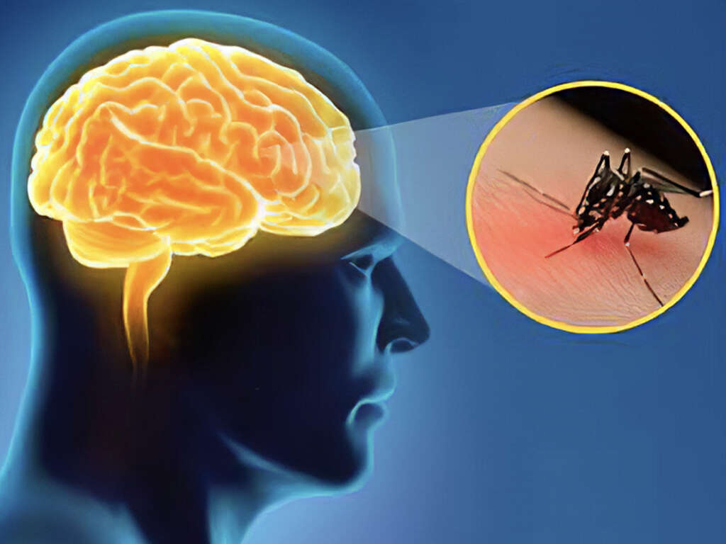 Viral Encephalitis