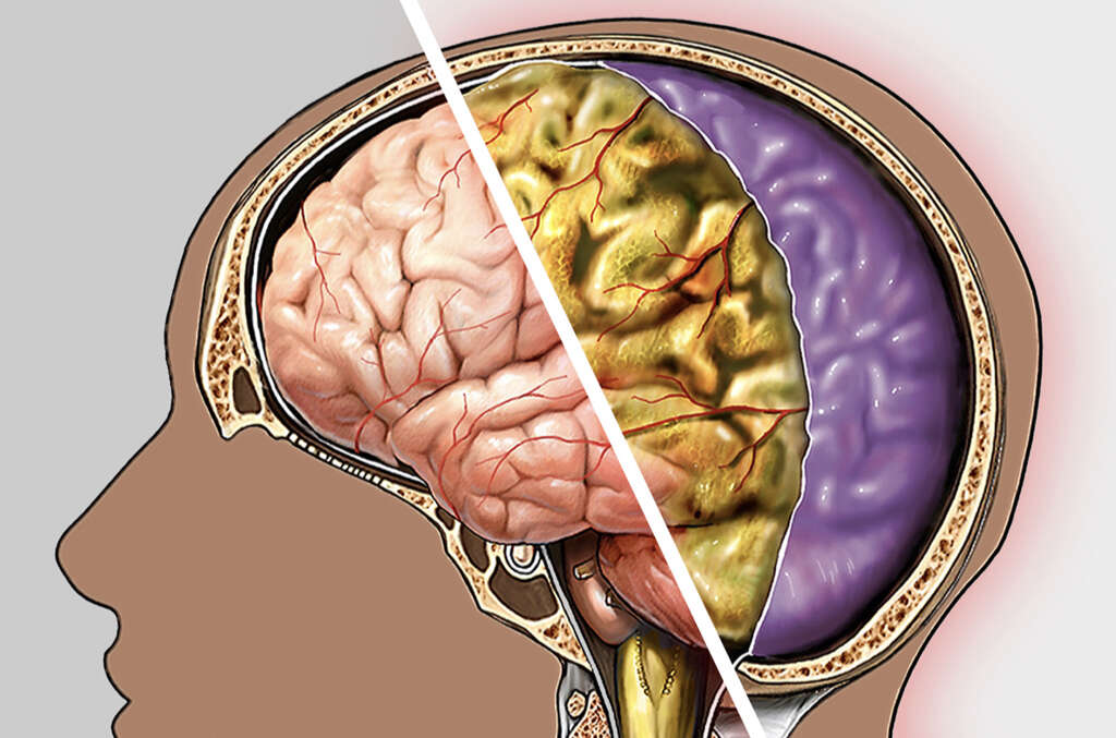 Viral Meningitis