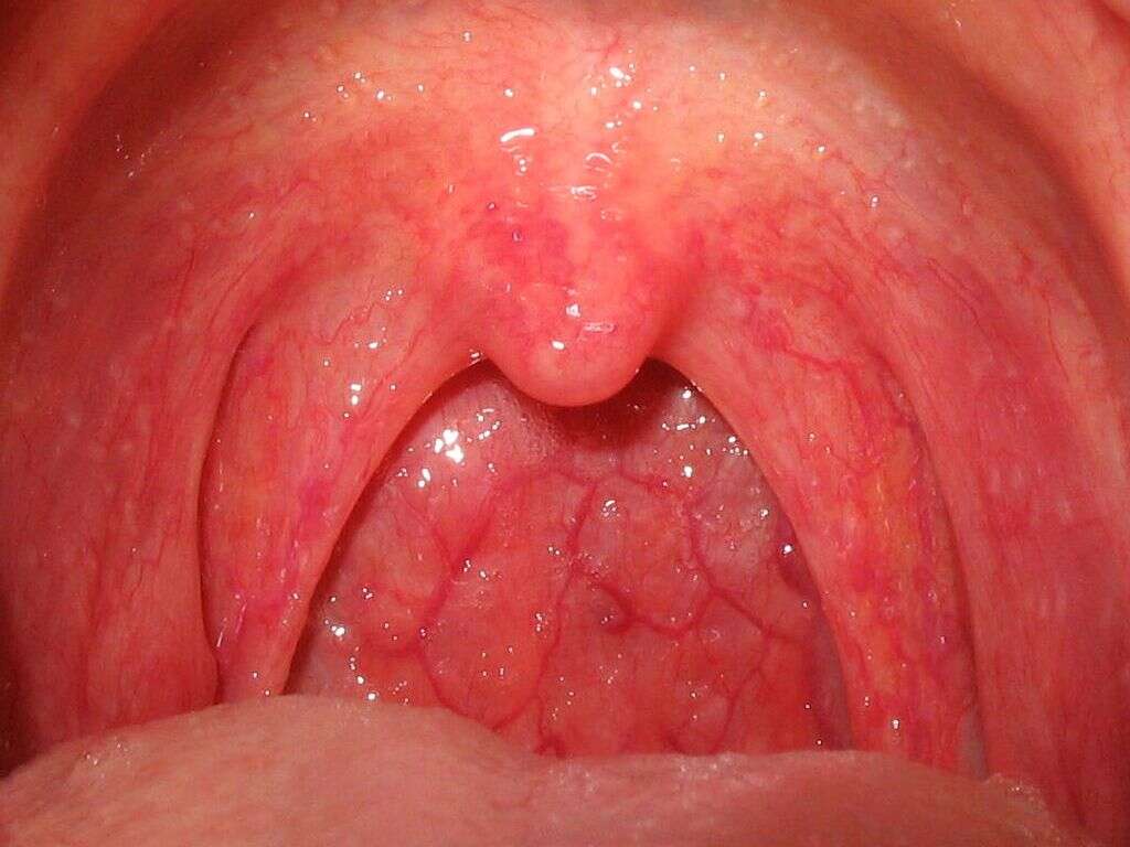 What Is Viral Pharyngitis?