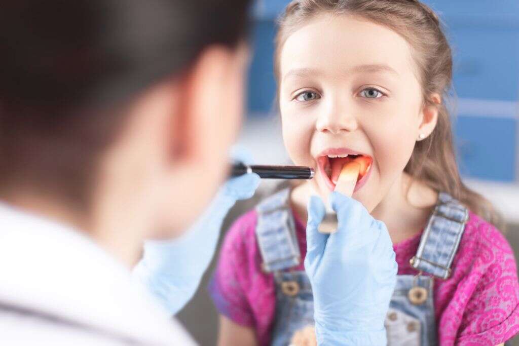 Viral Tonsillitis