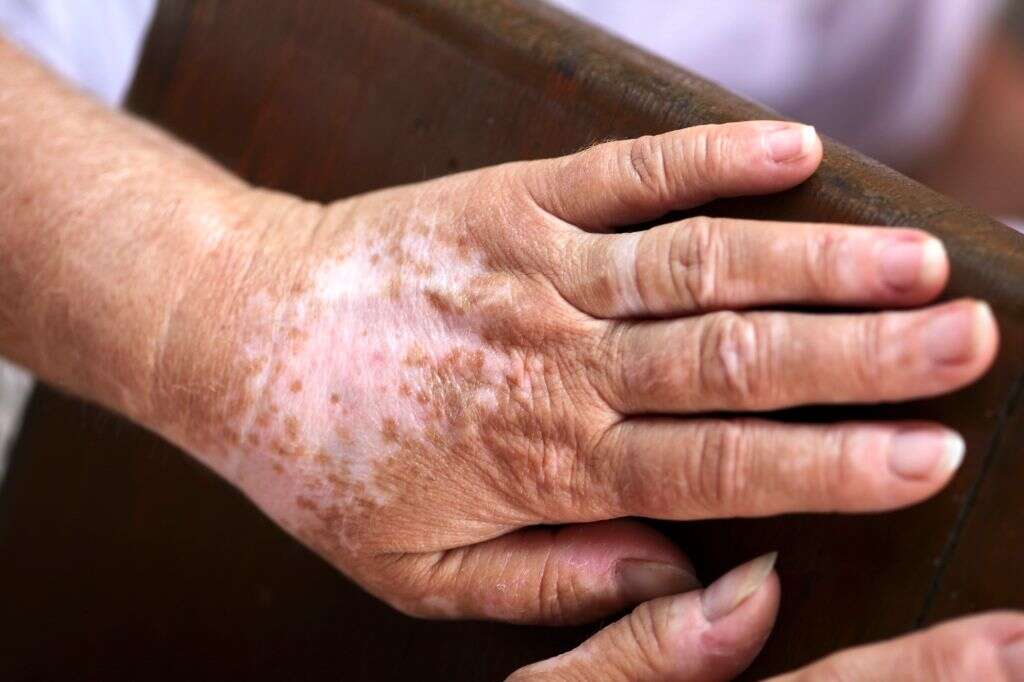 Vitiligo