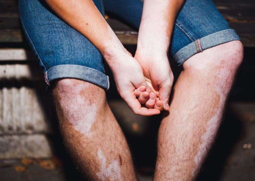 Vitiligo