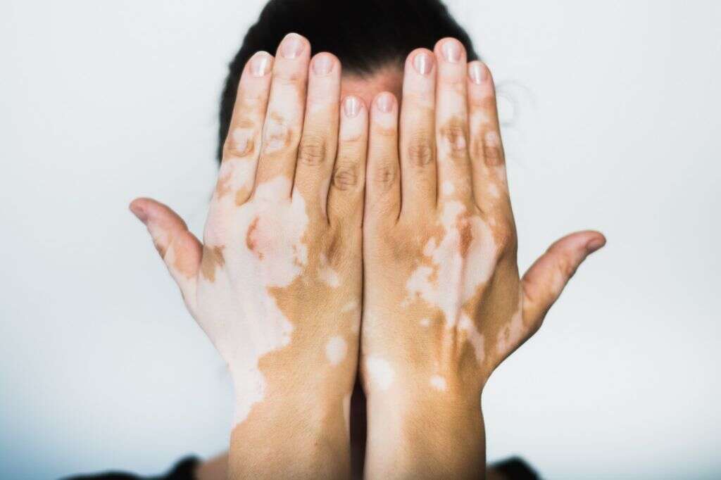 Vitiligo