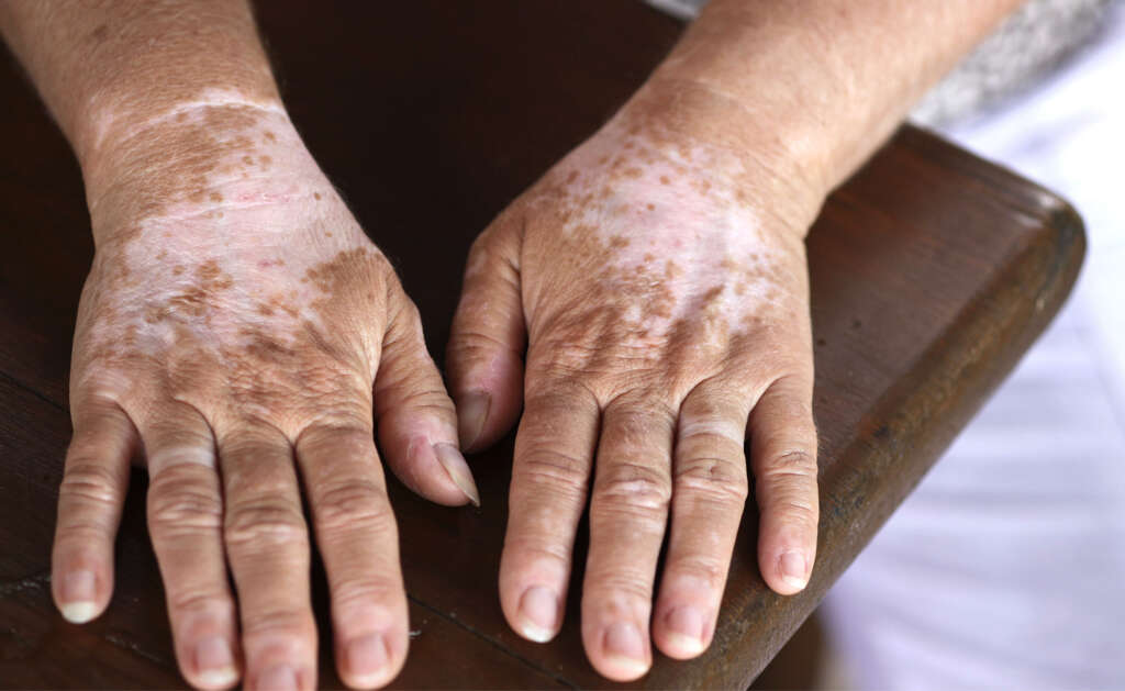 Waardenburg Syndrome