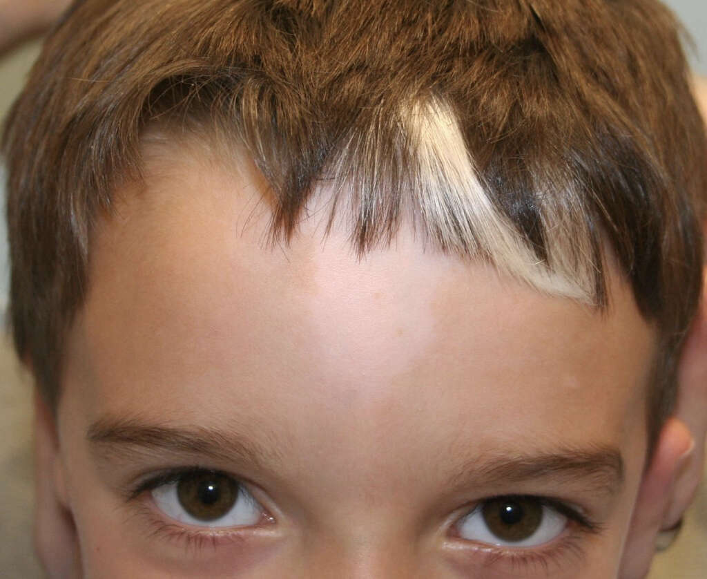 Waardenburg Syndrome