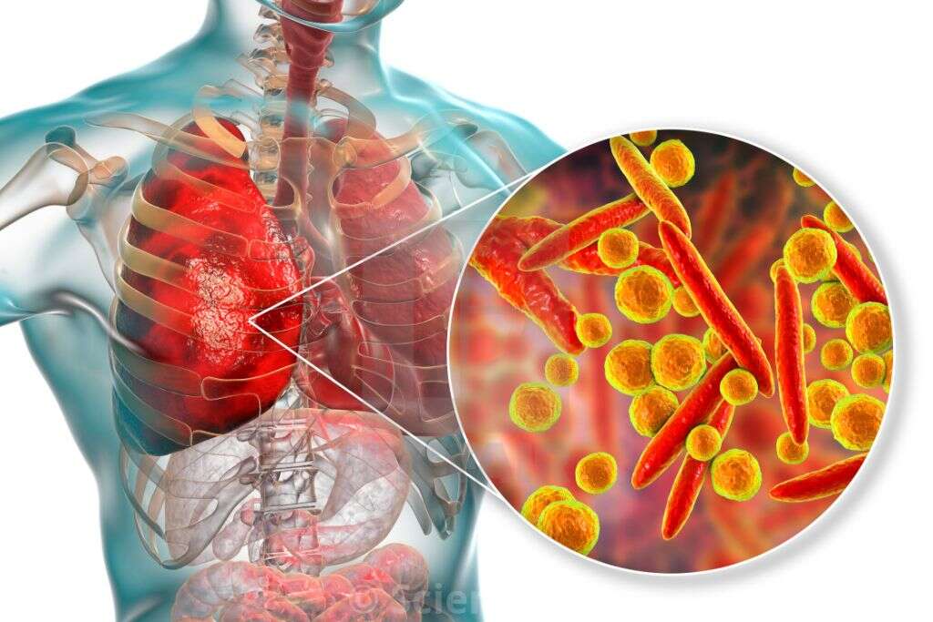 Walking Pneumonia