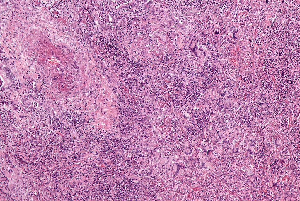 Wegener's Granulomatosis