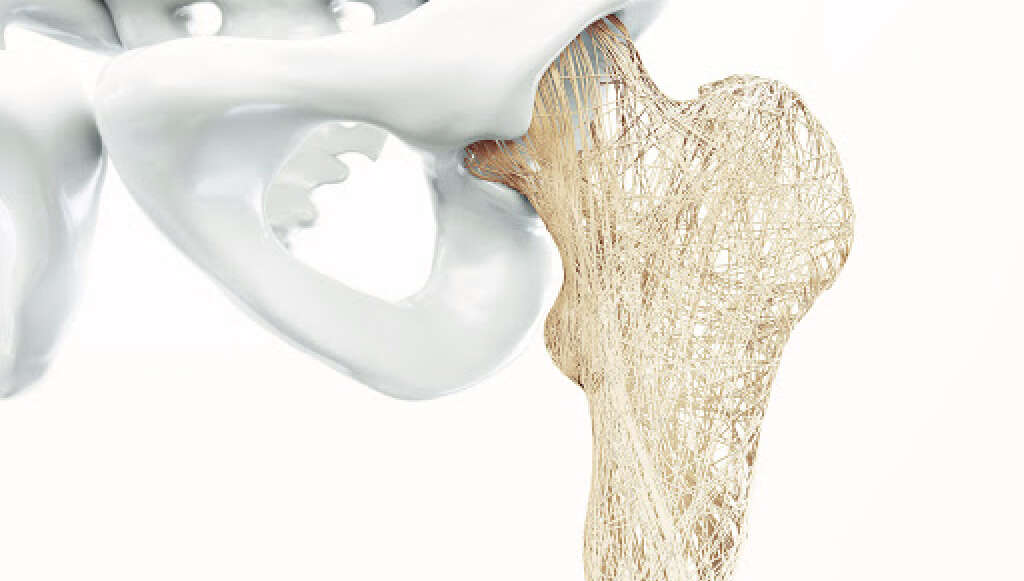 Werner Syndrome